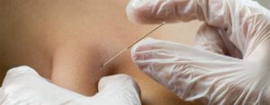 acupuncture 67 1280x500 300x117 Acupuncture for Neck Pain in Huntington